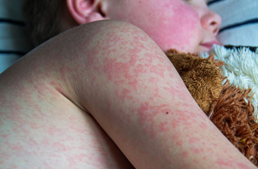 UK loses measles elimination status, warns WHO