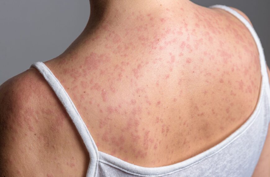 Measles cases continue to rise in England – and this is where outbreak could spread next