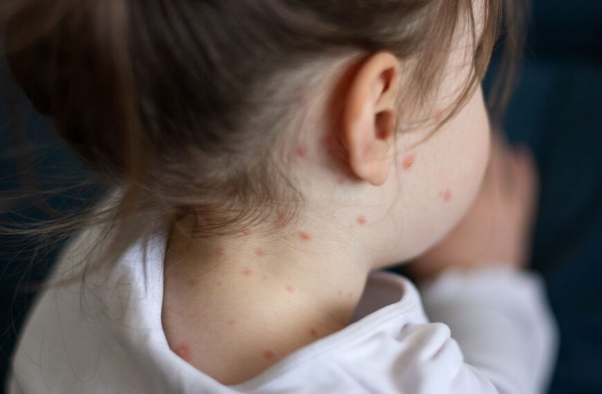 What are the symptoms of measles – and what should you do if you think your child is infected?