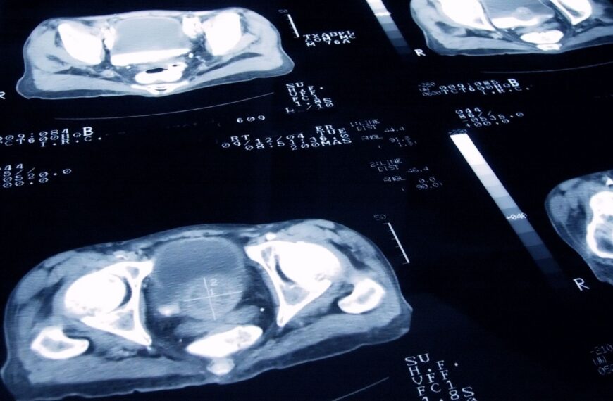 Cancer death rates fall to historic low – as types with biggest drop in fatalities revealed